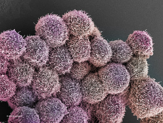 HER 2 Breasr Cancer Cells