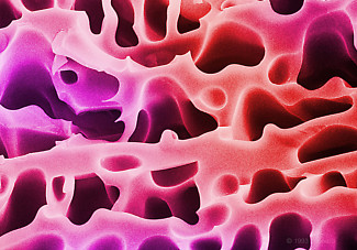 Follicle Stimulating Hormone Product: A  lyophilized injectable drug to enable fertility.