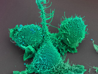 Prostate Cancer Cells with crazy various morphology