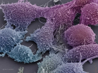 Prostate Cancer Cells