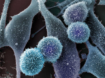 Melanoma Cells (skin cancer)