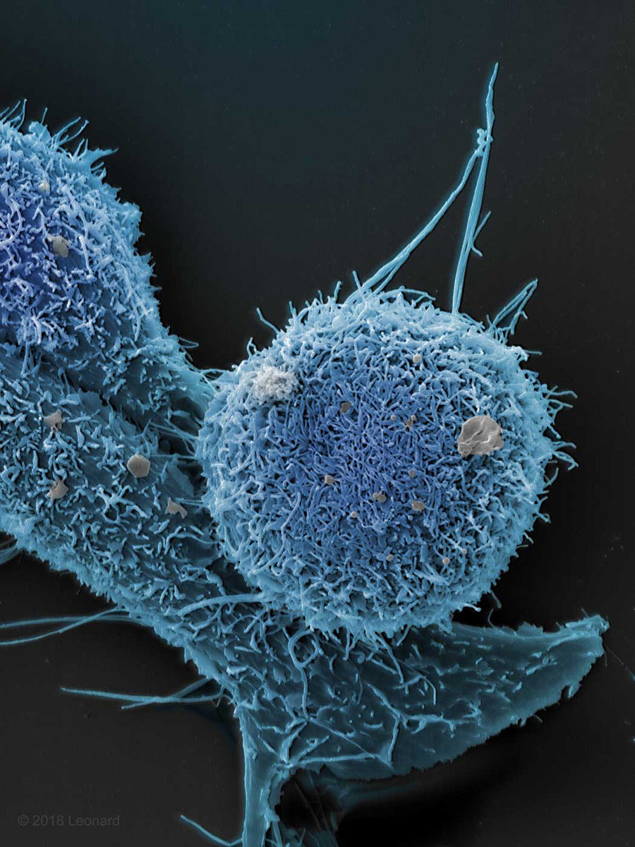 Prostate Cancer Cells, Not Italy, 